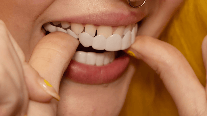 Blije klant met stralende, zelfverzekerde glimlach dankzij de makkelijke snap-on tanden veneers.
