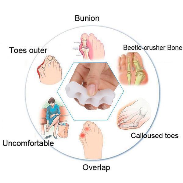 Medische illustratie van voetklachten zoals hallux valgus